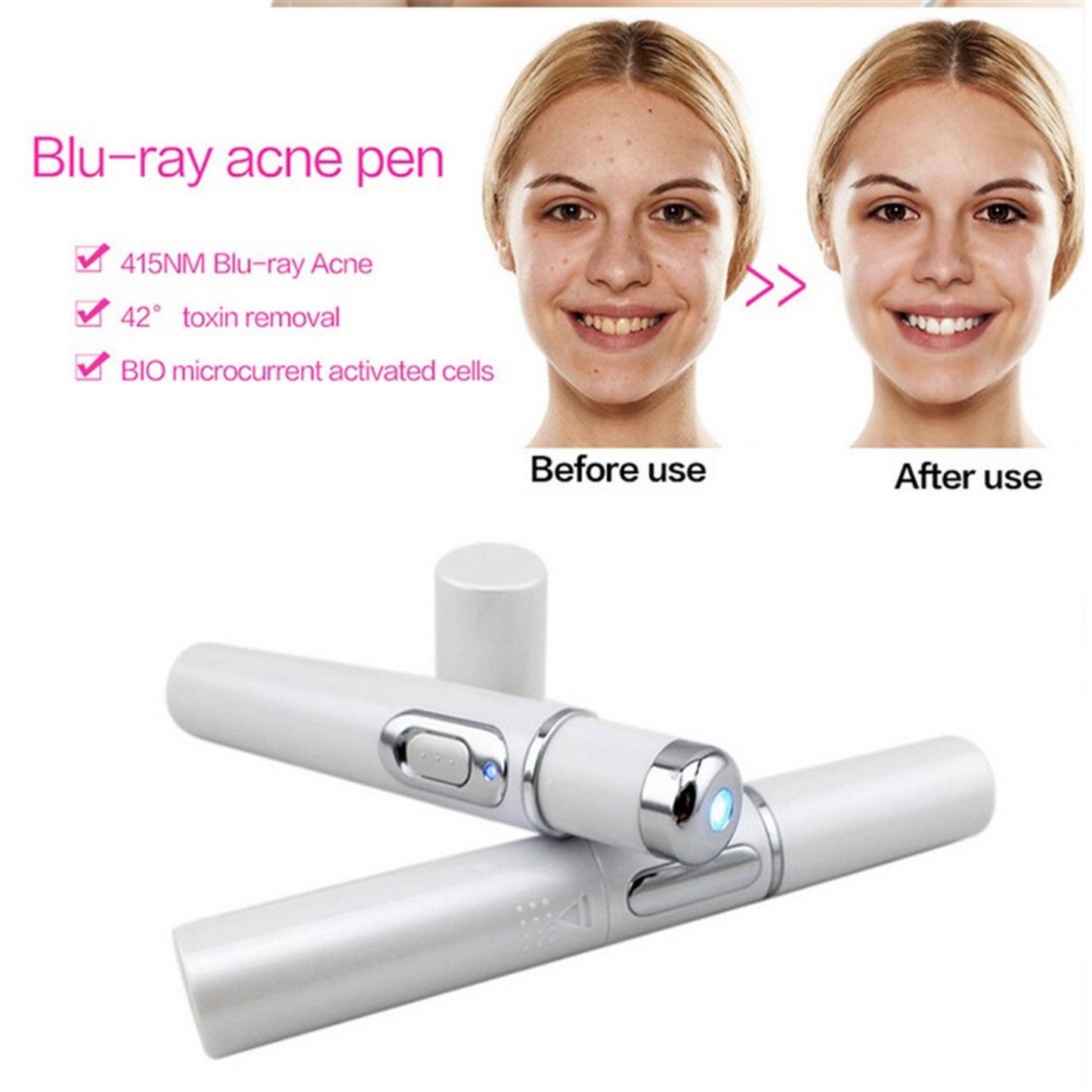 Blue Light Therapy Acne Treatment Device